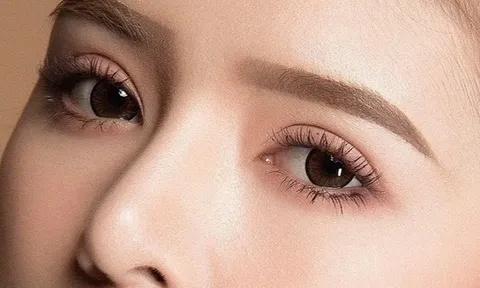 Cắt mí 5 ngày không nhắm được mắt, bác sĩ cảnh báo nguy cơ