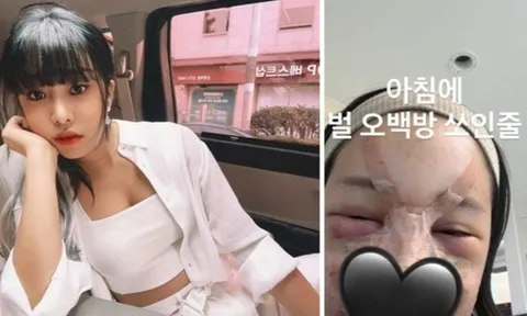 MC xinh đẹp Hàn Quốc bị biến dạng mặt nặng sau phẫu thuật thẩm mỹ cận Tết