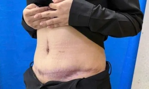 Bụng thiếu nữ biến dạng, hoại tử vì mũi tiêm trị sẹo sau khi hút mỡ