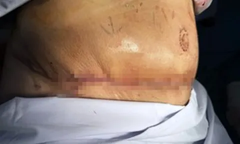 Tốn trăm triệu, đánh đổi tính mạng đi hút mỡ, thực hiện "combo" làm đẹp