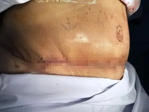 Tốn trăm triệu, đánh đổi tính mạng đi hút mỡ, thực hiện "combo" làm đẹp