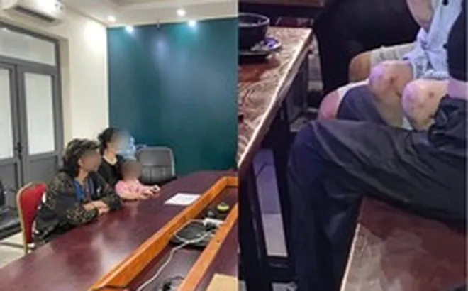 Mẹ của bé gái đưa con đến quán bia tại Hà Nội lý giải thế nào về các vết thâm trên chân, nghi bị bạo hành?